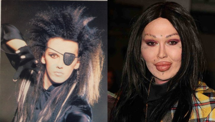 Pete-Burns-Plastic-Surgery-Before-and-After-Photos-Pictures-2.jpg